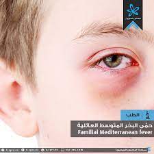 شو الفرق بين حامل المرض والمصاب فيه ؟ شو السلبيات الناجمة عن عدم أخذ دواء الكولشيسين ؟ Ø§Ù„Ø¨Ø§Ø­Ø«ÙˆÙ† Ø§Ù„Ø³ÙˆØ±ÙŠÙˆÙ† Ø­ Ù… Ù‰ Ø§Ù„Ø¨ Ø­ Ø± Ø§Ù„Ù… Øª Ùˆ Ø³ Ø· Ø§Ù„Ø¹Ø§Ø¦ Ù„ ÙŠ Ø©