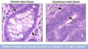 Maybe you would like to learn more about one of these? What Does Cancer Look Like Mayo Clinic