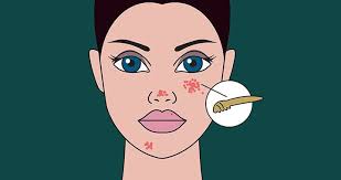 Image result for demodex rosacea