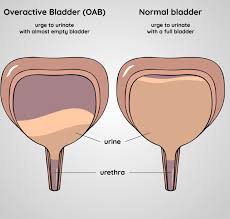Oab pará lança a central de alvarás 100% digital leia mais rpv e precatórios: Overactive Bladder Greenville County Limitless Therapy Wellness