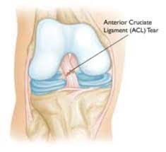 Find & download free graphic resources for knee injury treatment. Common Knee Injuries Orthoinfo Aaos