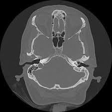 Image result for Myringosclerosis