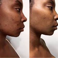 TOP 10 BEST Botox Injections near Jonesboro, GA