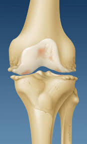 Arthrose Kein Altersbedingter Verschleiss