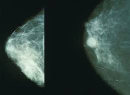 What does breast cancer look like on a mammogram? Breast Cancer Screening Wikiwand