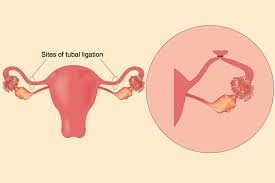 Pregnancy After Tubal Ligation Signs Symptoms And Risks