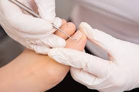 L Ongle Incarne Pied Et Chevillepied Et Cheville