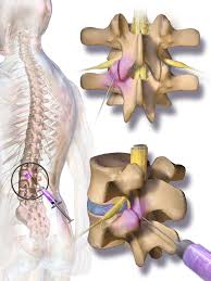 However, other experts believe that up to 6 injections per year is safe. Facet Joint Injection Wikipedia