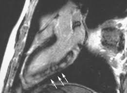 Myocarditis is classified as a rare disease but is estimated to affect thousands of adults and 3.1 million cases of myocarditis were diagnosed in 2017 (statistics posted in lancet, november 2018). Diagnosis Of Acute Myocarditis By Contrast Enhanced Cardiac Magnetic Resonance Imaging Revista Espanola De Cardiologia