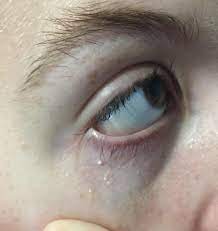 You can remove skin tags at home — but some diy tips on how to get rid of skin tags aren't exactly the skin tag removal creams are also available otc and can be effective. Skin Concern How To Get Rid Of Sensitive Milia Or Skin Tags Under The Eye Skincareaddiction