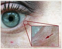 Image result for milium cyst on eyelid