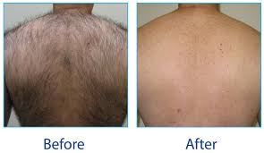 Trading acid for a razor blade is more of a lateral move than an outright improvement, don't you think? Ipl And Laser Hair Removal Confident Bodies