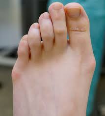 Wann eine operation sinnvoll ist welche methoden es gibt tipps für die nachsorge. Hallux Valgus Startpunkt