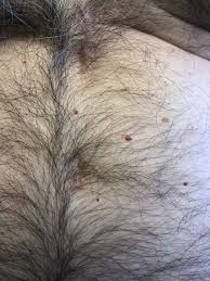 They often appear on the torso of the body, though they can develop anywhere, including the arms, legs, chest, and even the scalp. Bright Red Dome Shaped Papules Clinical Advisor