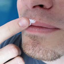 Lippenherpes öfter als sechs mal pro jahr haben oder dieser länger als zwei wochen andauert. Herpes Das Kommt Vom Kussen Stern De