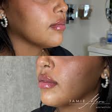 Schedule your appointment with Jamie Mora, PA-C @Studiophilly Link in my  bio 267-586-4978 Hablo Español 🇨🇴 Treatments/Pricing -SKINVIVE