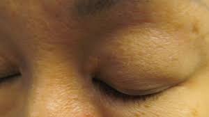 Image result for xanthelasma of eyelid
