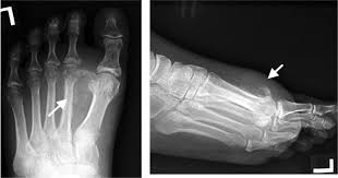 Image result for periostitis