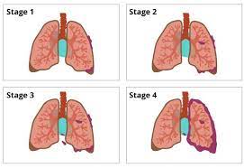 Maybe you would like to learn more about one of these? Mesothelioma Stages Staging Systems Categories Belluck Fox Llp