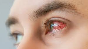 Image result for Keratitis