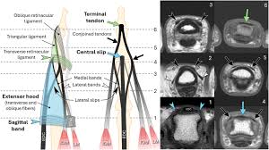 Image result for Elson Extensor Tendon Test