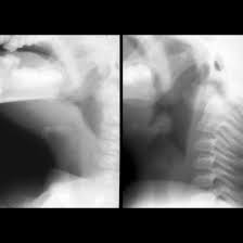 Image result for Epiglottitis