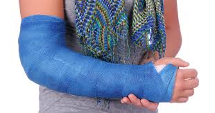Image result for Short Arm Cast