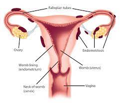 Dalam bahasa inggeris, senggugut dipanggil dysmenorrhoea. Ini Tanda Tanda Anda Mungkin Hidap Endometriosis