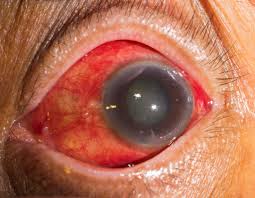 Glaucoma is a leading cause of blindness for people over 60 years old. Cannabis And Glaucoma What Does The Research Say Sensi Seeds