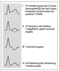 Bei jedem herzschlag verändert die herzmuskulatur ihre elektrischen eigenschaften, es fließt ein schwacher strom. Sb Wachstum Ekg Im Kindesalter Flashcards Quizlet