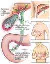 Be proactive and know the signs of a bile duct blockage