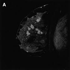 Maintaining a high volume of examinations in dedicated centers definitely impacts positively on experience in interpretation. Breast Cancer Imaging With Mri Radiologic Clinics