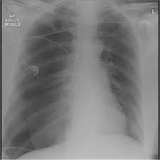 Depending on the cause of the pneumothorax, a second goal may be to prevent recurrences. Pneumothorax Post Cvc Insertion Radiology Case Radiopaedia Org
