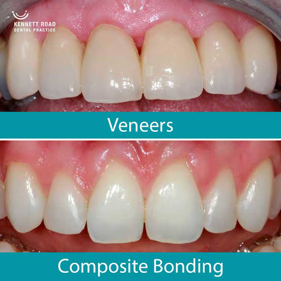 Composite Bonding vs Veneers: Which is Right for You? - Kennett Road Dental  Surgery Oxford