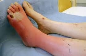 This is a dramatic drop in blood pressure that can lead to severe organ problems and death. Hautzeichen Der Zuckerkrankheit Springerlink
