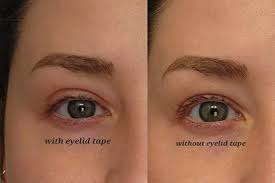 I'M Trying To Fake An 'Eyelift'': Here'S What Happened.