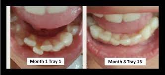 Smiledirectclub has 84 reviews with an overall consumer score of 4.5 out of 5.0. Smile Direct Club Reviews And Coupon Code Invisible Aligner Blog