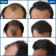 La calvizie colpisce l'80% degli uomini e il 50% delle donne. Impianto Capelli Uomo Off 78 Www Svrinfotech Net