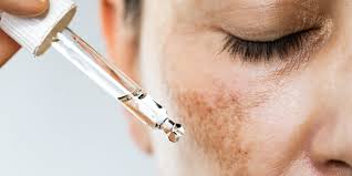 Melasma Treatment and Causes From Doctors