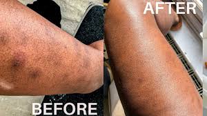 How to get rid of blemishes on your back? Pin On Remove Scars On Legs