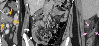 Image result for Multisystem Inflammatory Syndrome