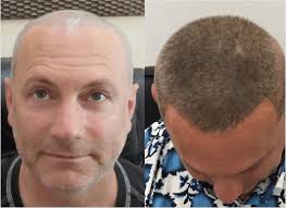 Since keratosis pilaris affects the skin around the hair follicle, laser hair removal isn't exactly a home run treatment for eliminating kp entirely. Laser Hair Regrowth For Men Hair Loss Laser Treatment