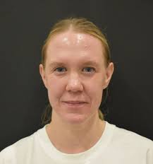 8 Point Liquid Facelift