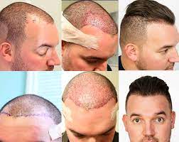 You may notice that the short hair shafts that were transplanted are shedding. Hair Growth After Hair Transplant After Follicular Transfer Fue Hair Transplant