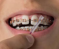 Once threaded, gently floss up and down between your gums on each side. Best Ways To Keep Your Teeth Clean Healthy While Wearing Braces