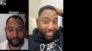 Sean behnam md, abhrs, specializes in african american hair transplant. Pin On Hair Transplants For Black Men