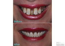 As with all of our dental implant patients here in north london, we'll take. Same Day Dentures Before And After 212 Smiling