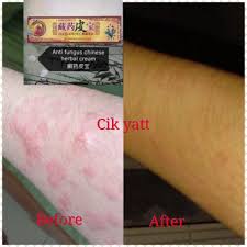 Ianya telah digunakan semenjak dari dahulu lagi sehinggalah sekarang. Original Eczema Treatment Cream Herba Cacar Air Kurap Shopee Malaysia