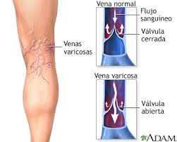 Venas Varicosas Medlineplus Enciclopedia Medica