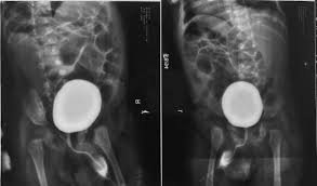 Image result for Voiding Cystourethrogram